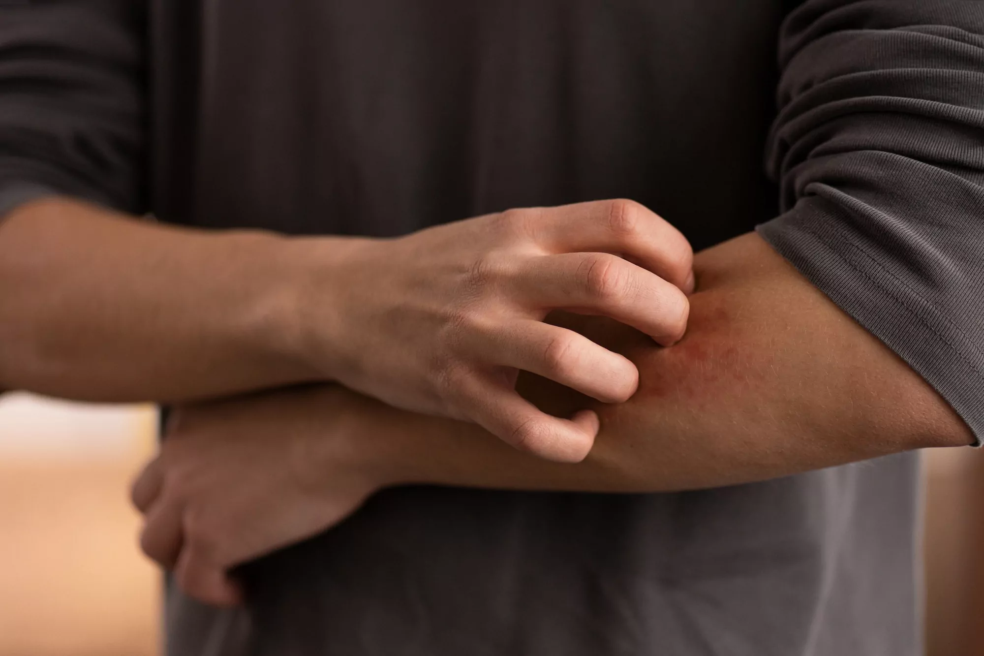 Alergia i AZS – Jak dieta łagodzi swędzenie skóry?